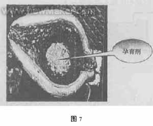 缸套离心铸造模具设计的改进